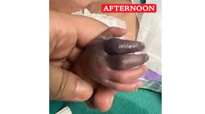 Newborn’s Hand at Risk of Amputation After Alleged Wrong Injection