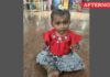 10-month-old girl dies after treatment in Coimbatore